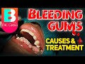 Bleeding Gums 101