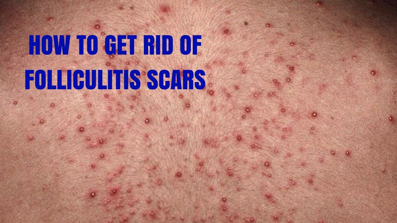 How To Get Rid Of Folliculitis Scars Youtube