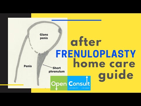 Video: Hoe u zich kunt voorbereiden op en herstellen na een Frenuloplastiek