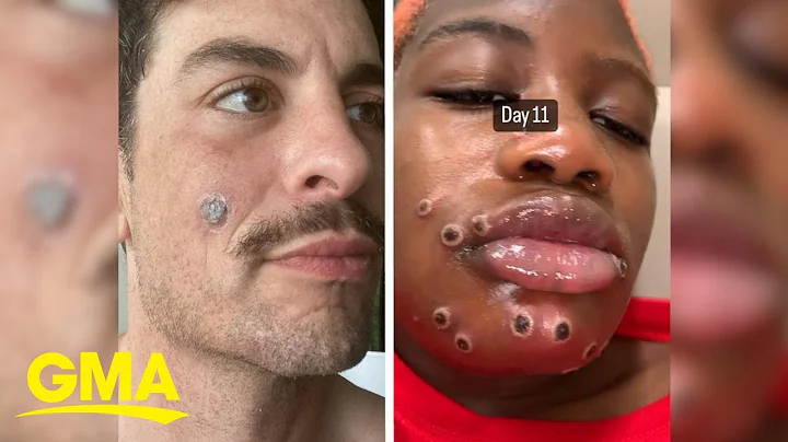 This is what its like living with monkeypox