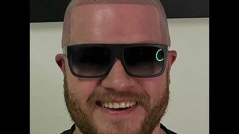 The Scalp Micropigmentation, SMP  Journey after 2 sessions at ScalpCarolinas