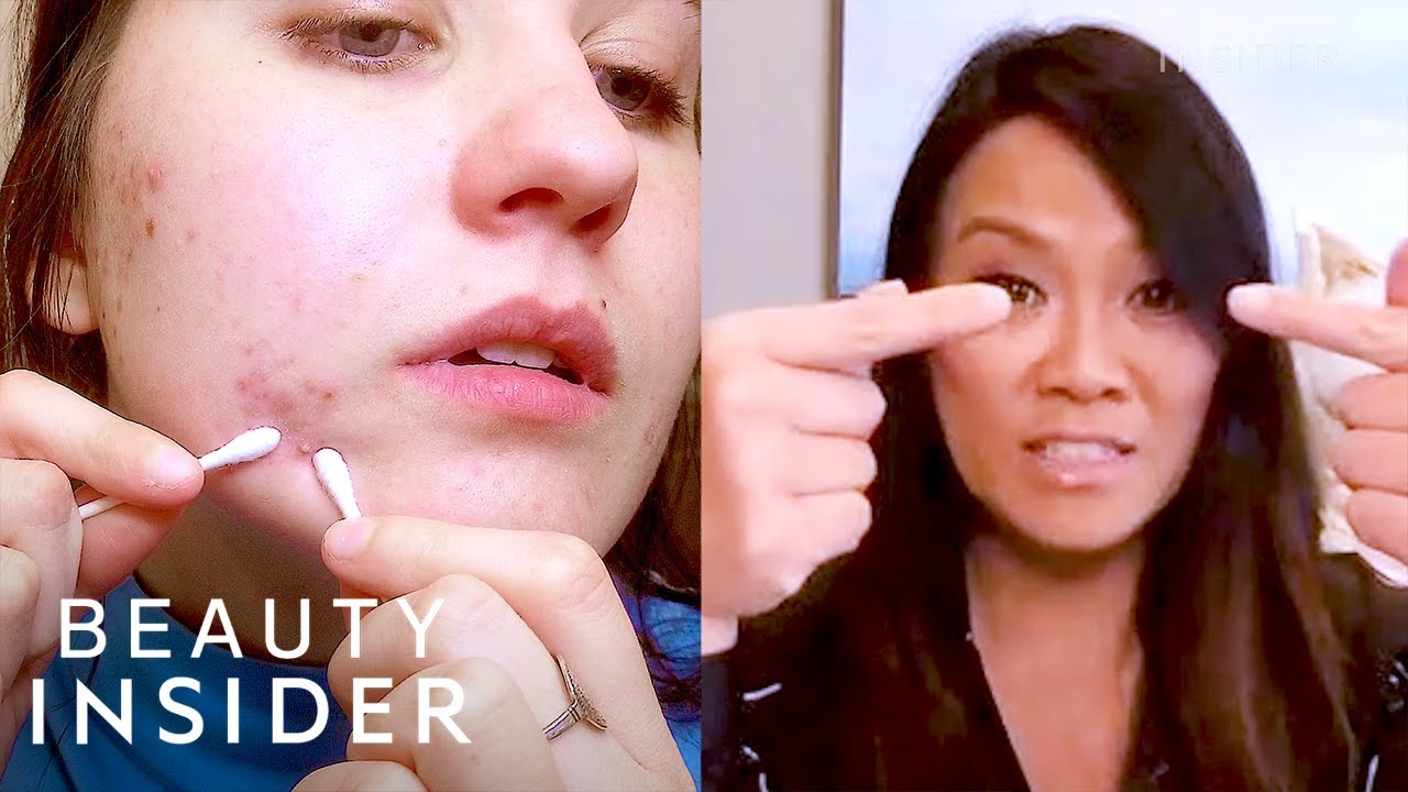 Industrieel kant vaardigheid How To Pop A Pimple Yourself With Dr. Pimple Popper | Beauty At Home -  YouTube