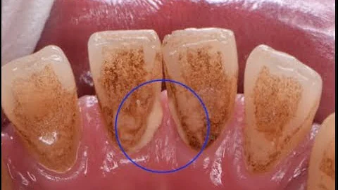Porque fica preto entre os dentes?