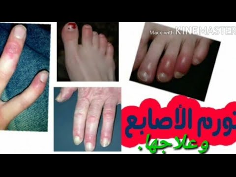 علاج تورم وتثليج الأصابع الناتج عن برد الشتاء