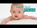 أسباب حدوث الشفة الأرنبية وشق سقف الحلق 
