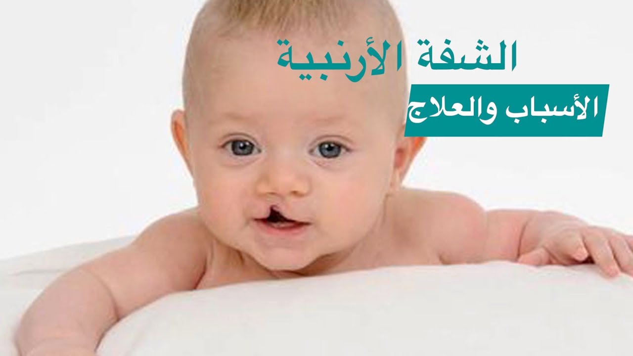 أسباب حدوث الشفة الأرنبية وشق سقف الحلق