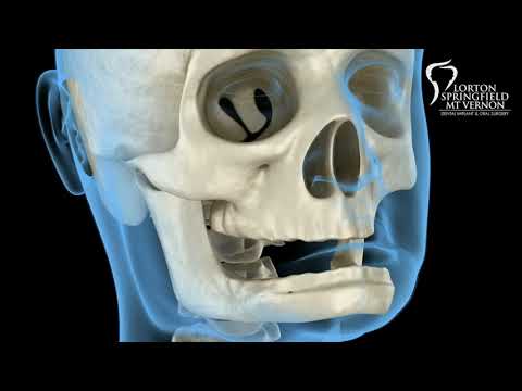 Mandibular Jaw, bone recession after losing teeth. Medically accurate dental 3D animation