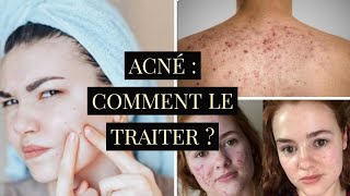 ACNÉ ( CAUSES , TYPES , TRAITEMENT , PRÉVENTION )