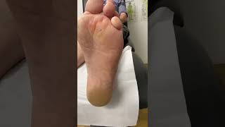 Watch How An Aussie Podiatrist Tackles Tough Forefoot Corn! #Podiatry #Cornremoval #Footcare