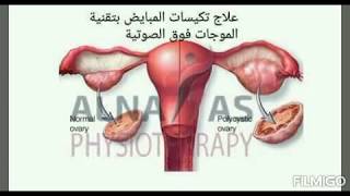 مشكلة دهون المبايض ( تكيس المبايض ) و الطريقه الأسرع لحلها