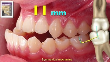 Open Bite Correction - 2020 AAO Winter Chris Chang - 3｜【Chris Chang Ortho】CC541