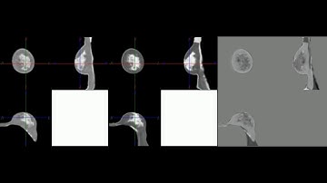 Biomechanically-assisted prone to supine breast image registration
