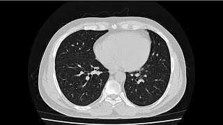 Normal chest ct