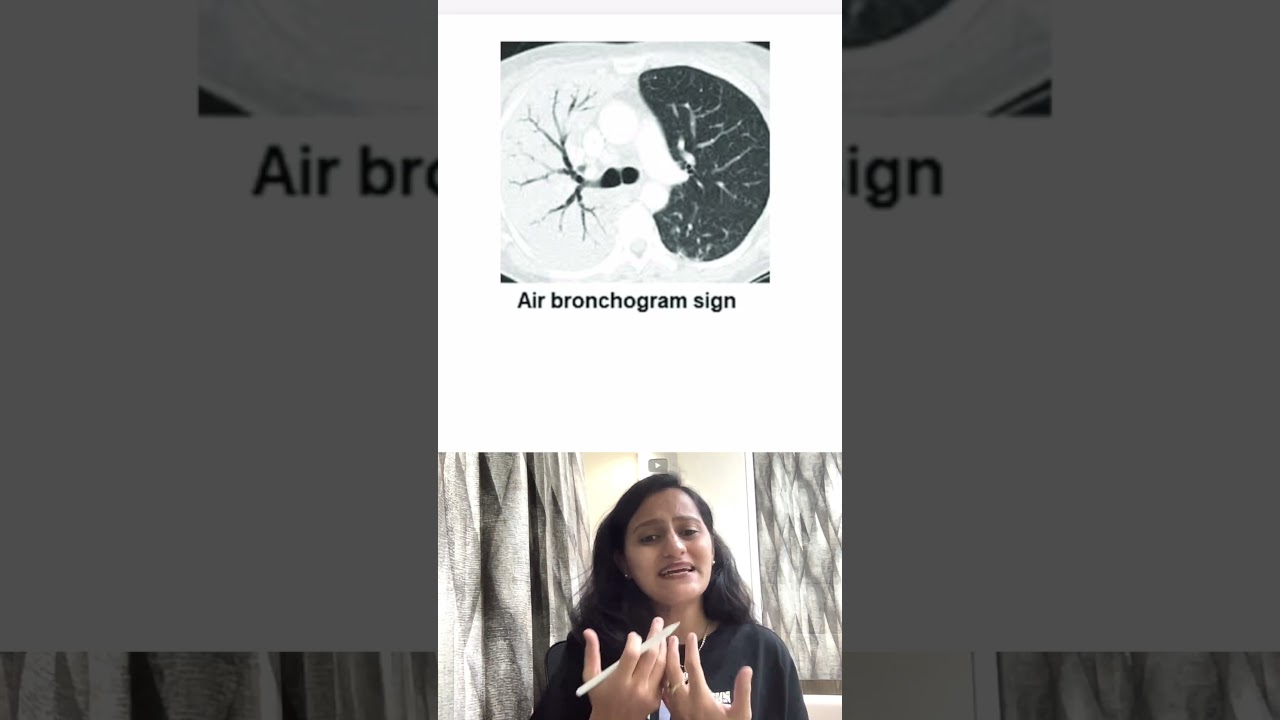 Air bronchogram sign| A-Z Radiology signs | Episode A| Dr. Nikita Nanwani