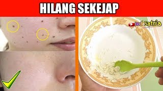 Download lagu Cara Menghilangkan TAHI LALAT Secara Cepat Dengan 2 Bahan Ini Saja Cara Menghilangkan TAHI LALAT Secara Cepat Dengan 2 Bahan Ini Saja