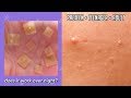 TESTING ACNE PIMPLE STICKERS OVER NIGHT on PRETEEN, TEENAGER, + ADULT SKIN!