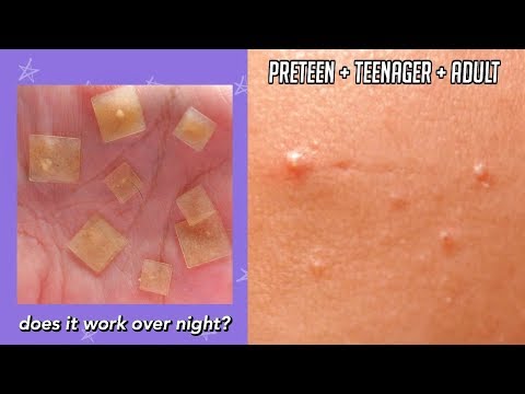 TESTING ACNE PIMPLE STICKERS OVER NIGHT on PRETEEN, TEENAGER, + ADULT SKIN!