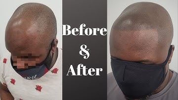 Does Micro scalp pigmentation look real (before & after)