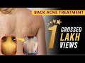 Back Acne Treatment | पीठ के मुँहासे का इलाज | Truncal Acne treatment in hindi Sakhiya Skin Clinic