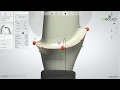 3DBioCAD - Dental System Implant Abutment Design Pt. 1