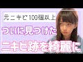 【ニキビ100個以上】長年悩み続けたわたしがついに見つけた、ニキビ跡撃退方法!【スキンケア】