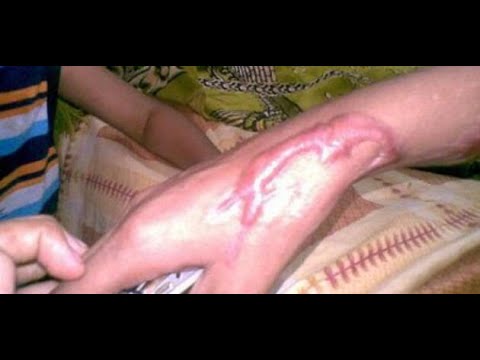طرق لإزالة آثار الجروح والحروق القديمة
