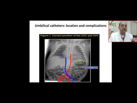 Case 32 umbilical catheter location and complications, normal and malposition