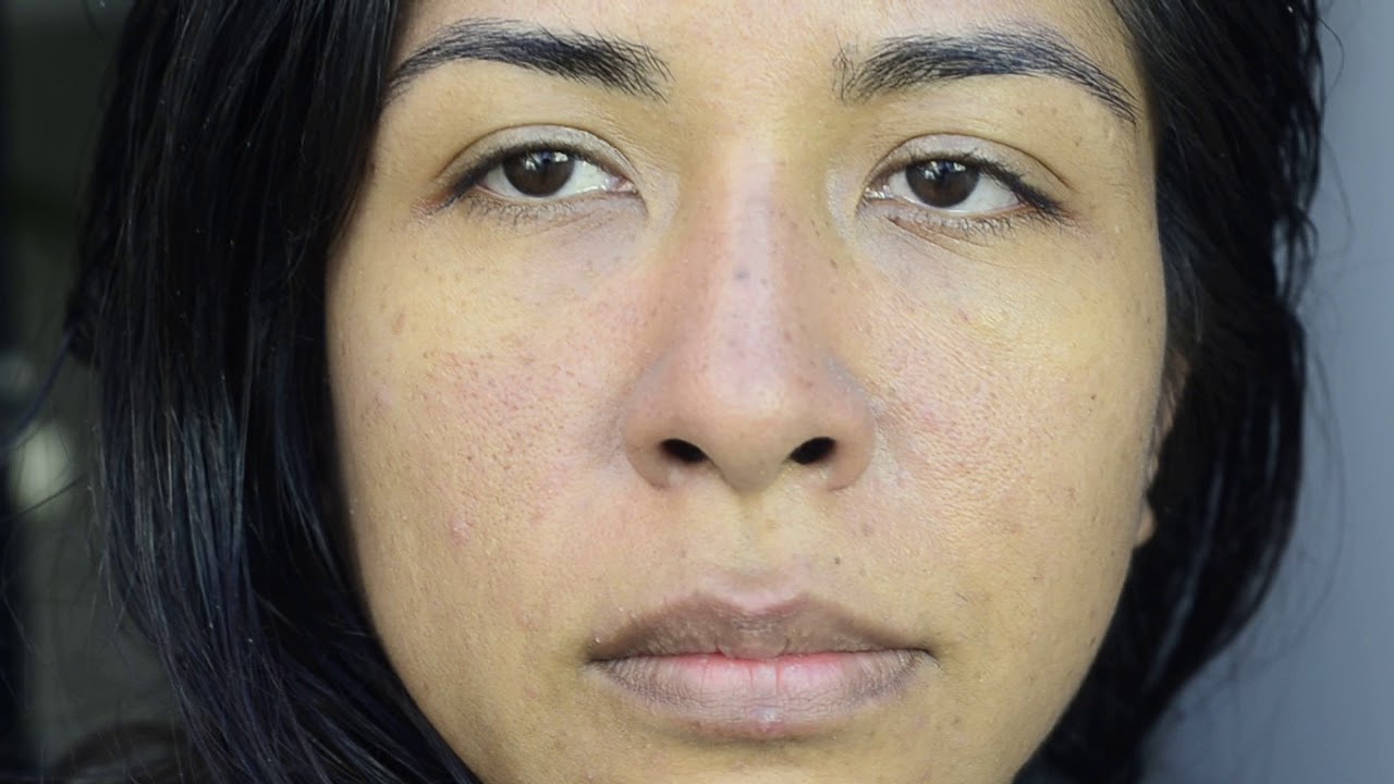 que es una celulitis en la cara que es una celulitis en la cara