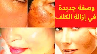 وصفة جديدة في إزالة الكلف بطريقة طبيعية وفي متناول الجميع Remove melasma naturally