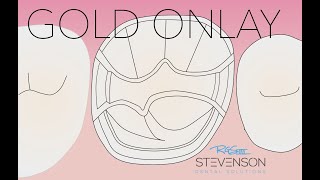 MOD Gold Onlay Preparation on Typodont #3 Kilgore