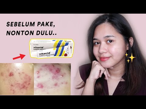 Video: Cara Mudah Menggunakan Krim Tretinoin: 13 Langkah (Dengan Gambar)