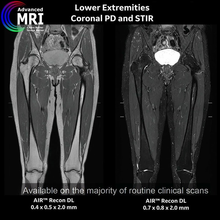 AIR Recon DL GE Healthcare announced U.S. FDA 510(k) clearance of AIR Recon DL.