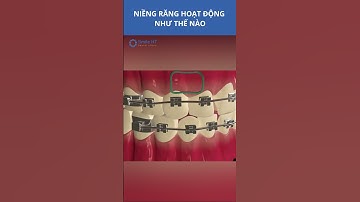 Niềng răng là gì ? I Nha Khoa Smile HT #shorts #niengrang #nhakhoa #smileht #niềngrăng