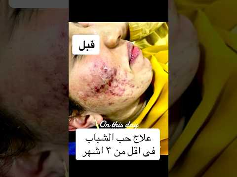علاج حب الشباب حب الشباب تقشير تقشير الوجه