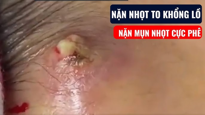 Những Pha Nặn Mụn Hấp Dẫn: Hướng Dẫn Chăm Sóc Da An Toàn Và Hiệu Quả