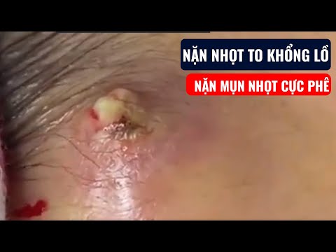 Video NẶN NHỌT TO KHỔNG LỒ | Nặn mụn nhọt cực phê - youtube