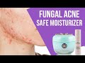 Top 5 Moisturizers for Fungal Acne-Prone Skin: Effective Solutions and User Experiences