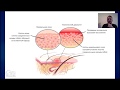 Запись вебинара Сергея Макарова по атопическому дерматиту (12 ноября 2016)