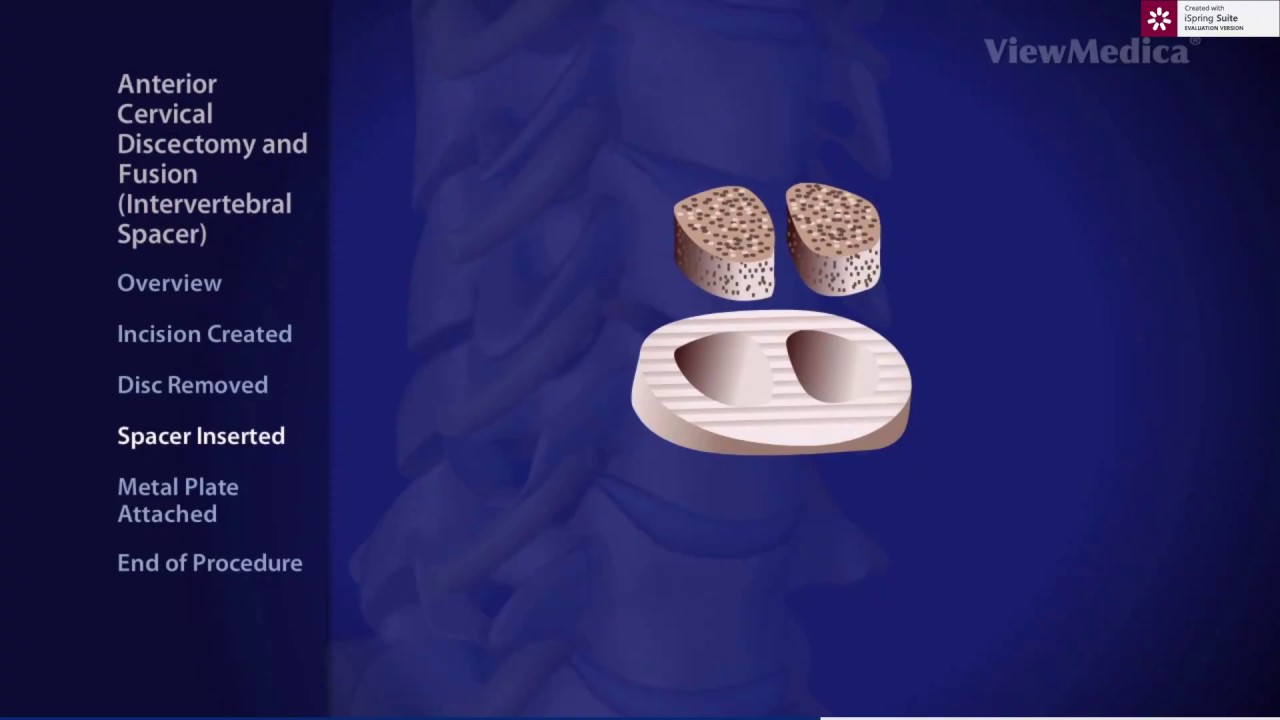 Radiculopatia Cervicala Cervicobrahialgia Durerea Pe Brat Dr