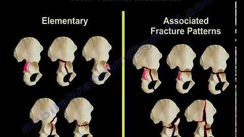 Acetabulum Fracture Types  - Everything You Need To Know - Dr. Nabil Ebraheim