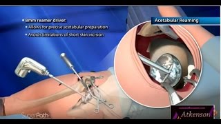 superpath total hip replacement animation