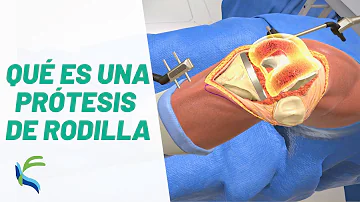 ¿Qué porcentaje de operaciones de prótesis de rodilla tienen éxito?