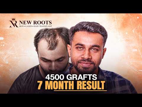 7 Months of Growth & a Big THANK YOU! ❤️ | 4500 Grafts | Hair Transplant Cost and Results in Kolkata