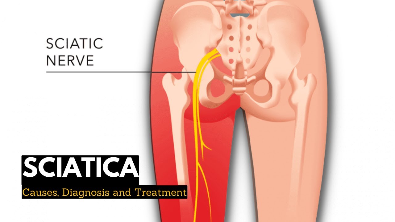 Sciatica: What It Is, Causes, Symptoms, Treatment & Pain Relief