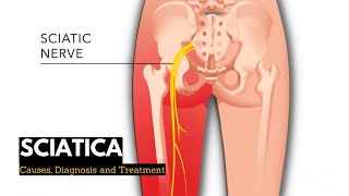 Sciatica, Causes, Signs and Symptoms, Diagnosis and Treatment screenshot 4