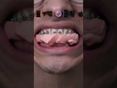 Snacks vs. Braces