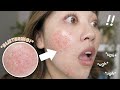 Acne "PEEL OFF SHIELD" except it ruined my skin..