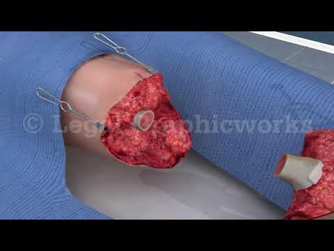 Video: At Tage Det Af At Tage Det Hele Af: Hvornår Er Amputation (ekstraktion, Enukleation, Splenectomizing Osv.) Det Rigtige Valg?