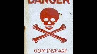 What is Gum Disease? by Dentalism 7,252 views 10 years ago 2 minutes, 2 seconds