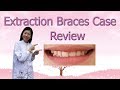 Extraction Braces Case Review